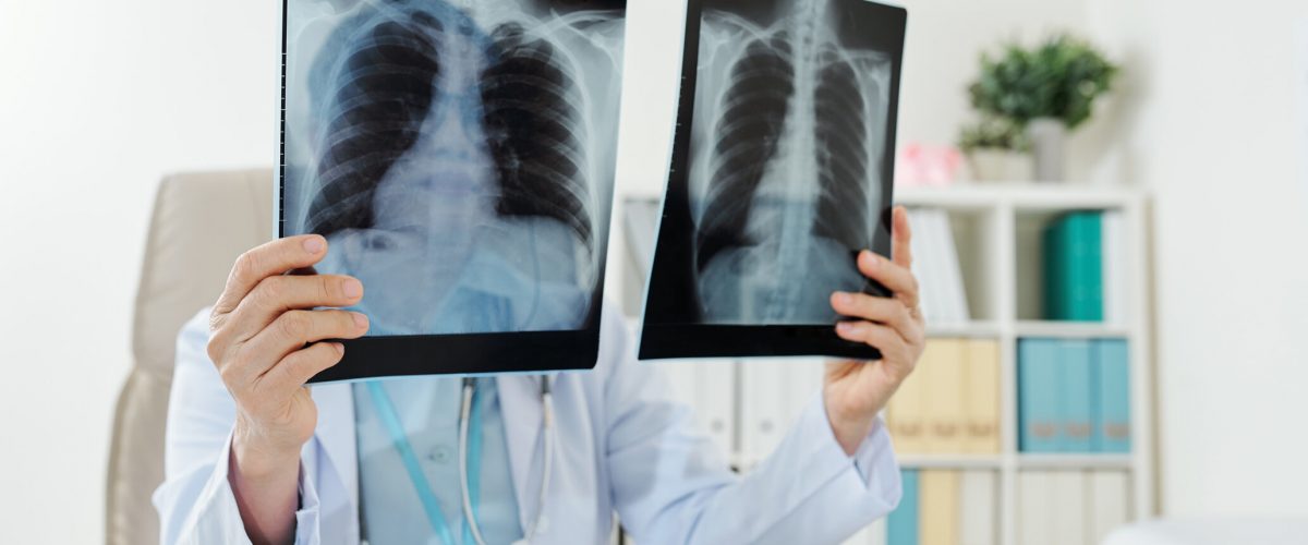 Doctor comparing two lungs x-rays of patient after his recovery